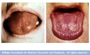 r7_burningmouthsyndrome