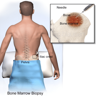 BoneMarrowBiopsy